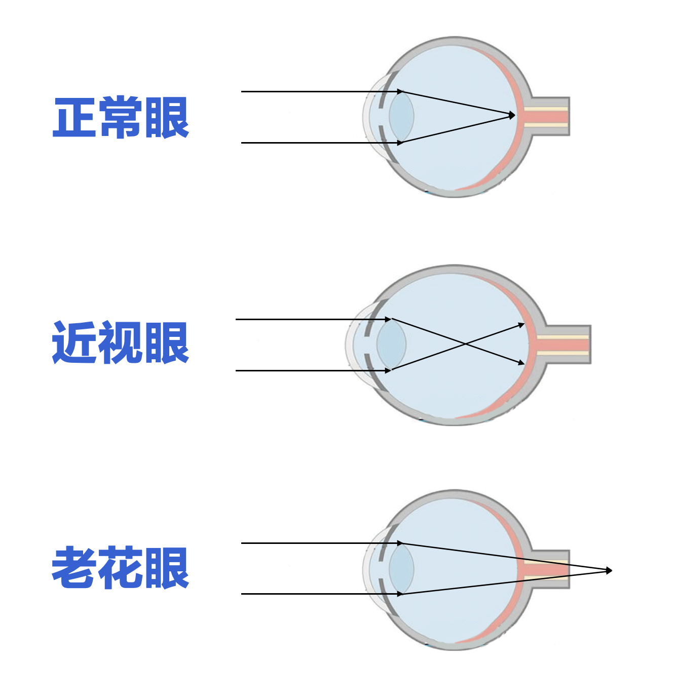 多焦镜